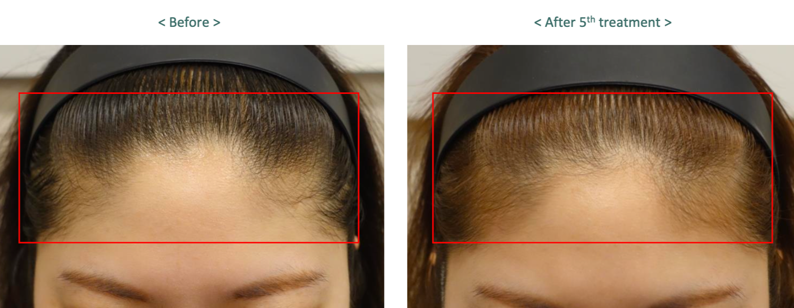 Before and after comparison of hair treatment on a person's head.