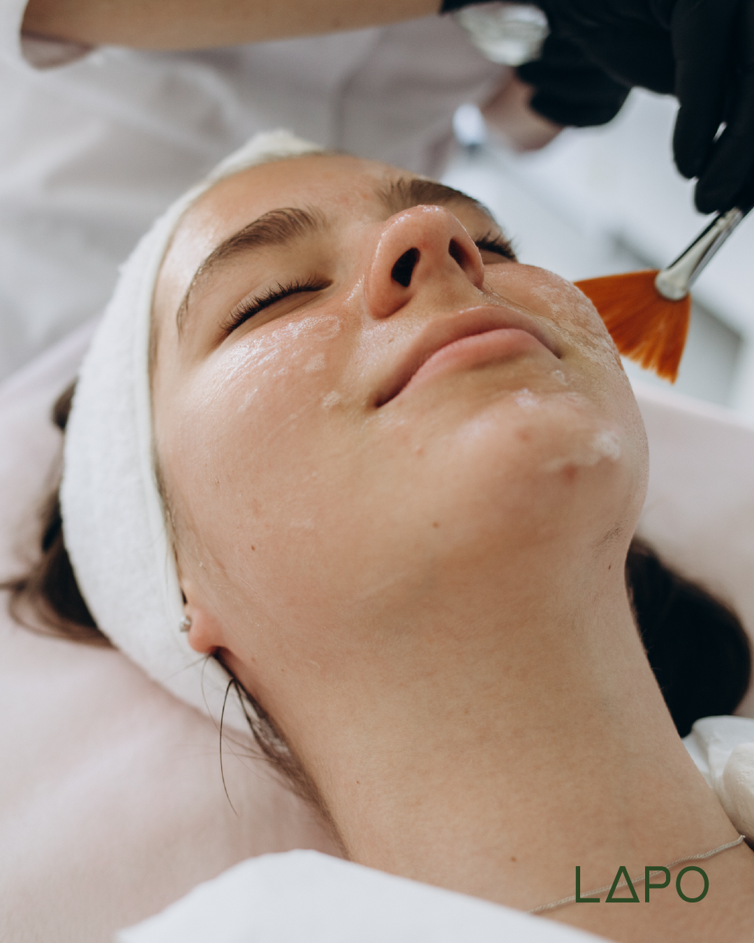 Chemical Peel (19% Azelaic Acid)