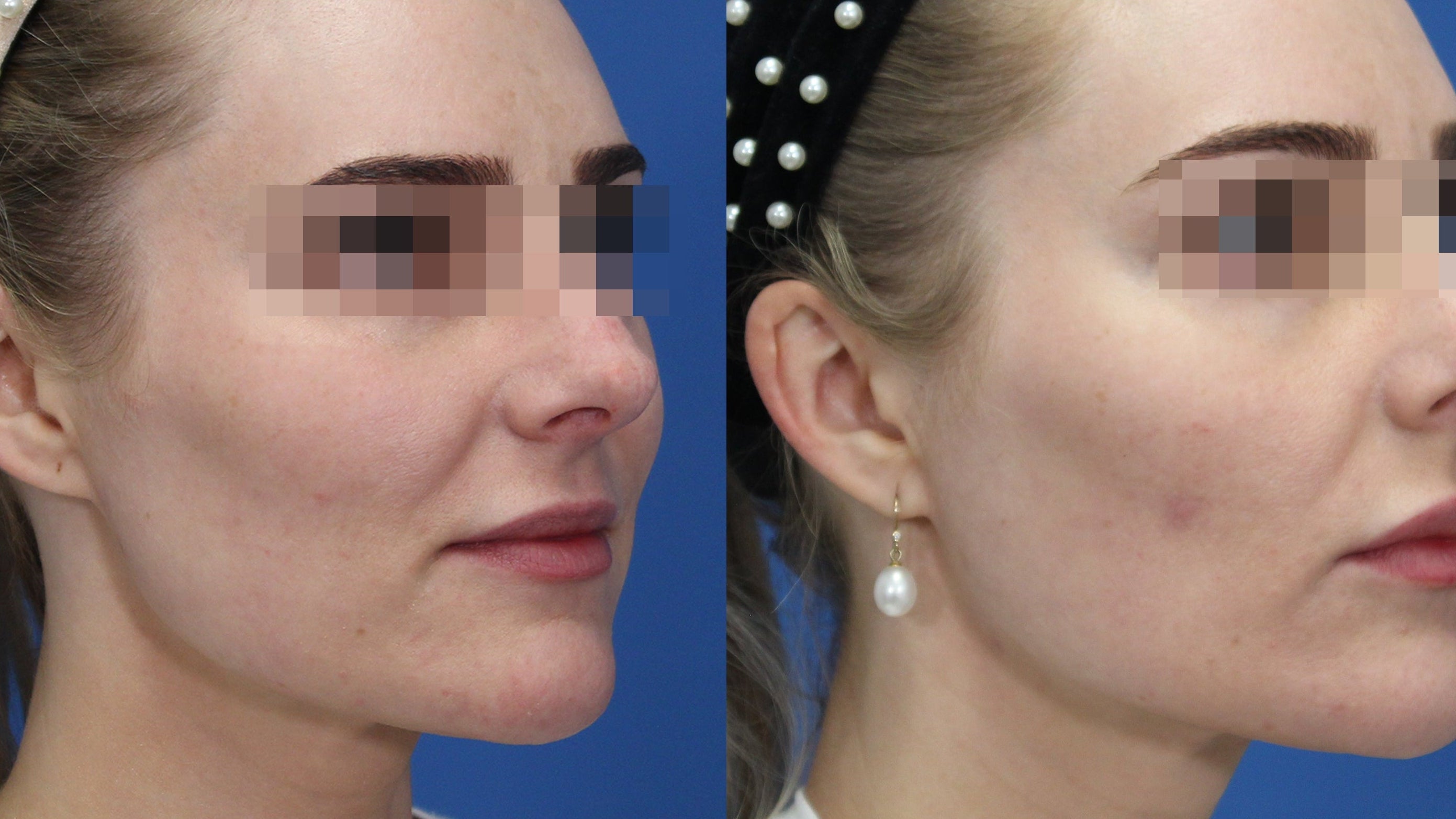 Before and after comparison of a woman's face with 'Secret RF' treatment, showing visible improvement.