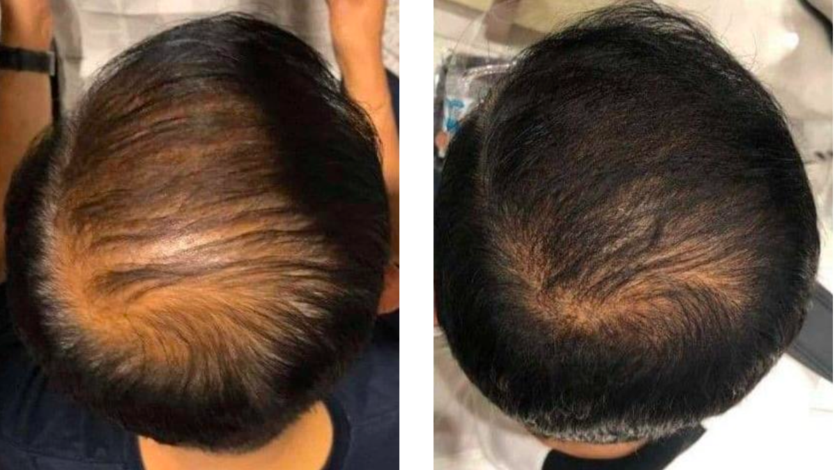 Before and after comparison of hair treatment on a person's head.